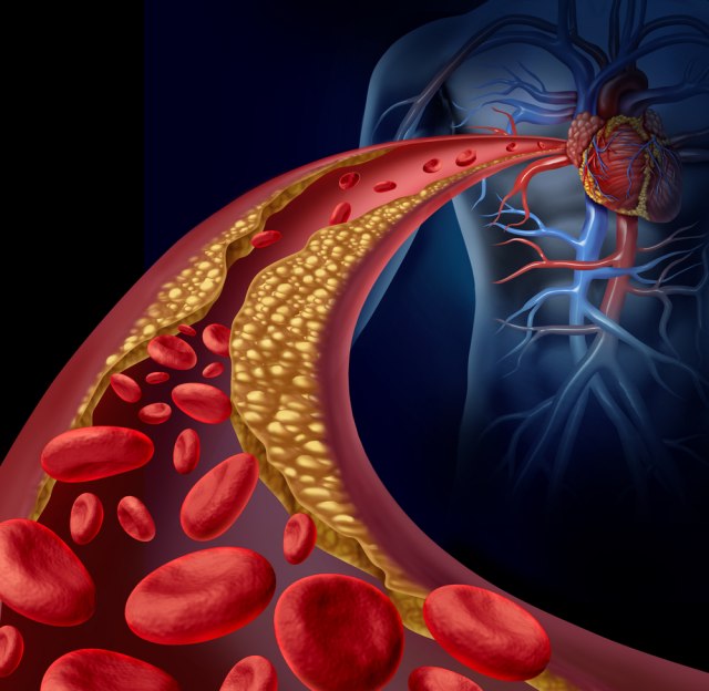 Visok nivo masnoća u krvi može da ošteti organe